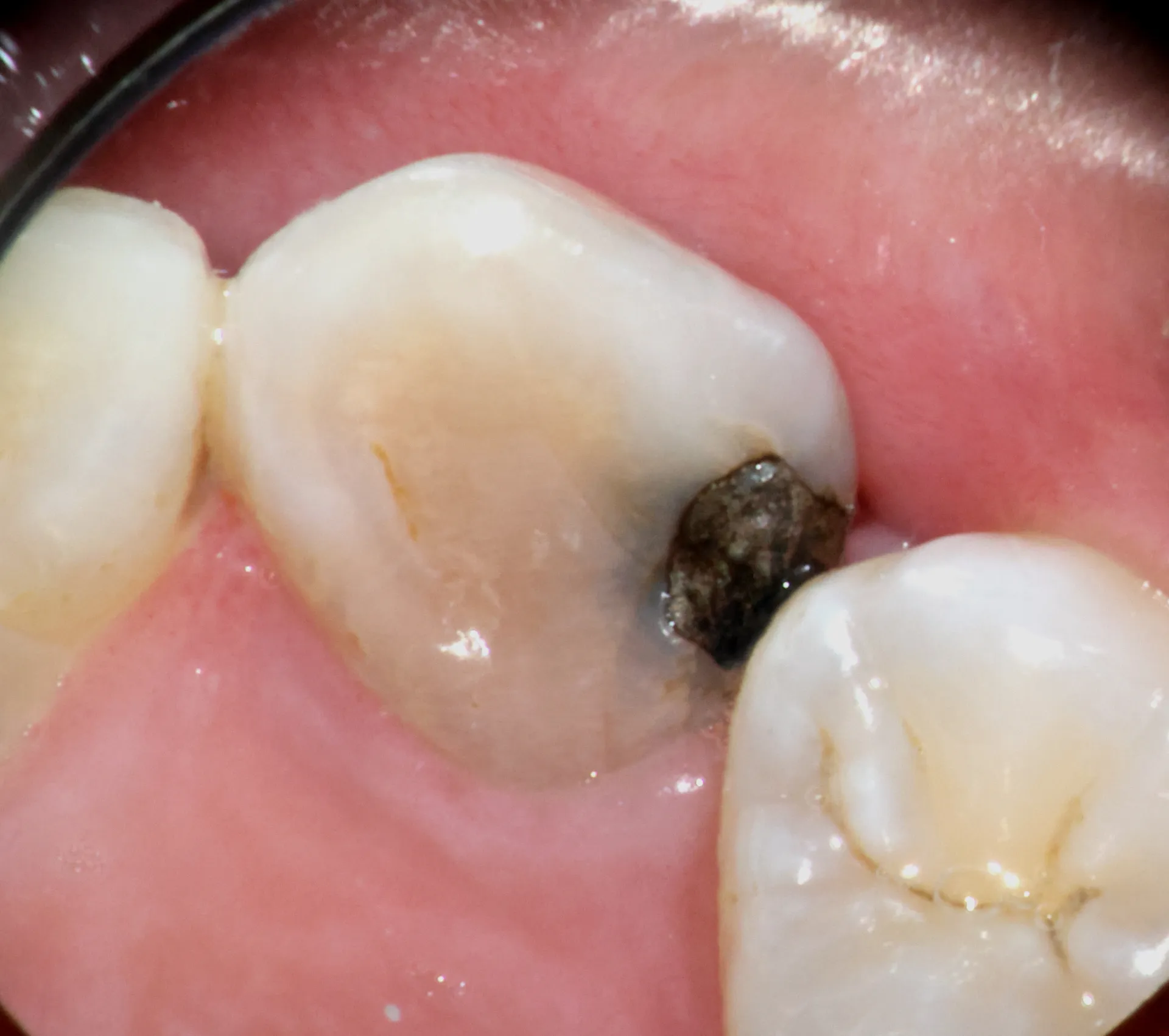 Lingual view of discolored maxillary incisor before internal bleaching procedure showing extent of staining